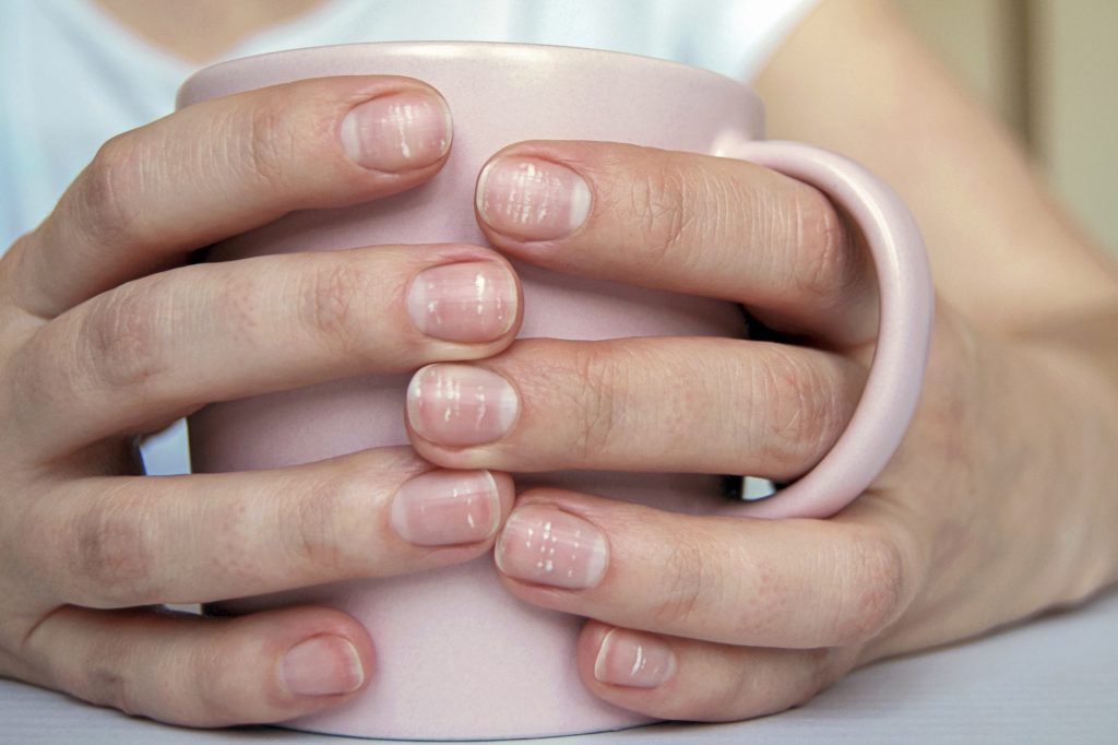  White spots on fingernails are due to calcium deficiency. 