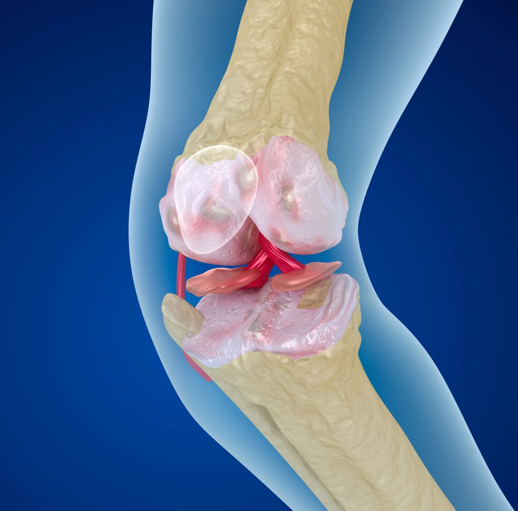 cartilage erosion of the knee
