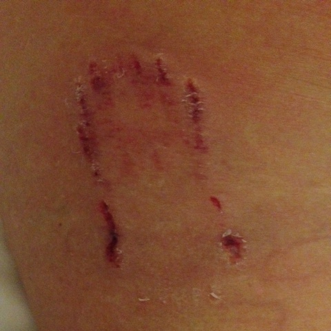 Arm wound depicting physical injury, symbolizing trauma and potential PTSD.